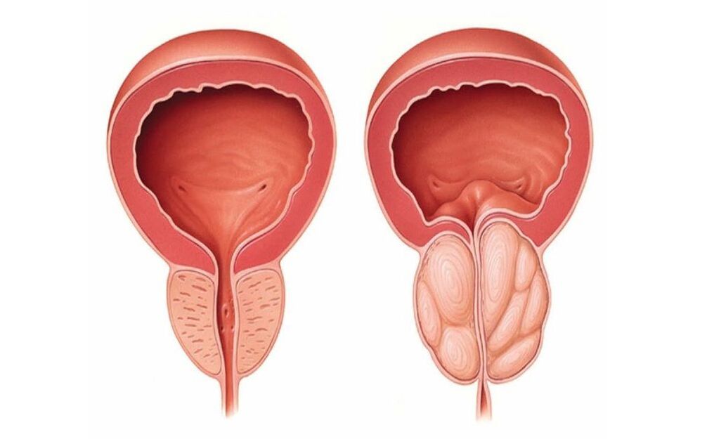 normalna in vneta prostata