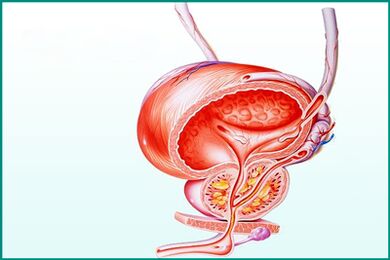 Vnetje prostate pri akutnem prostatitisu je omejitev za spolnost