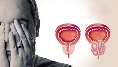 Razlogi za razvoj prostatitisa pri moških