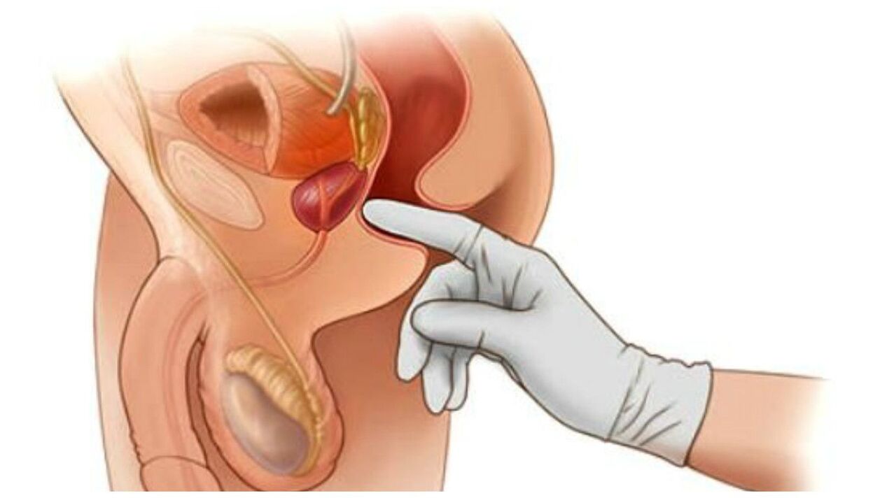 masaža prostate
