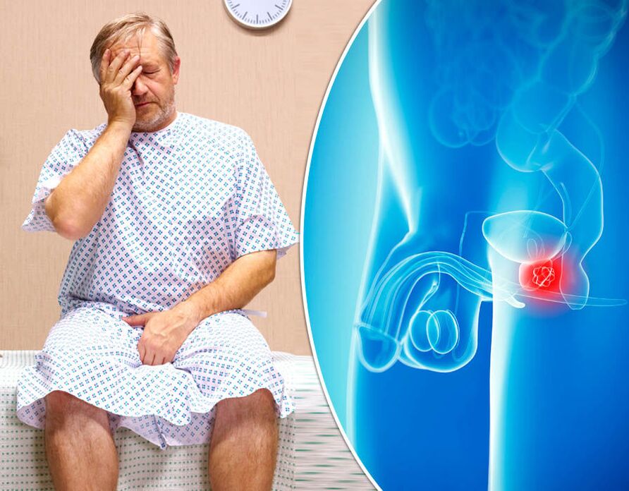 Moškemu s prostatitisom diagnosticirajo bolezen