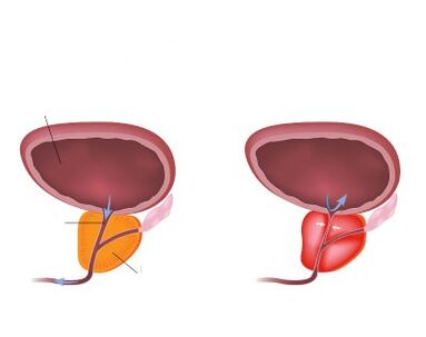 Normalna in vneta prostata